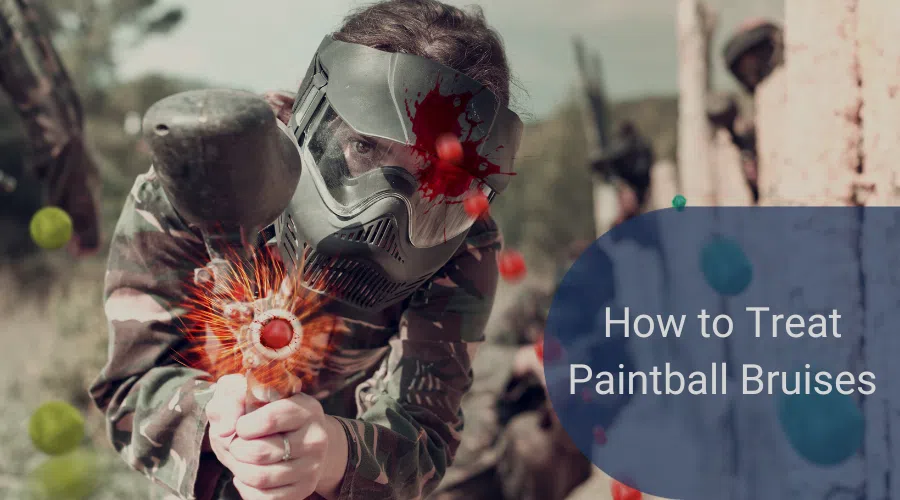 how to treat paintball bruises